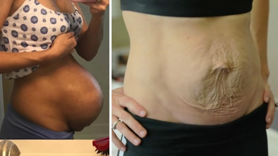 Bikini Competitor Embraces Stretch Marks After Twins
