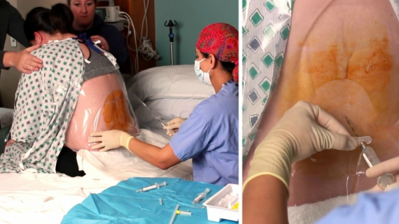 Birth Guide: Epidural Anaesthesia for Pregnant Women