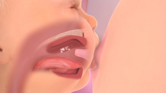 Breastfeeding Problems: Infant Factors