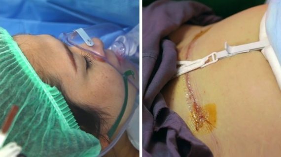 C-Section Recovery: What You Need To Know