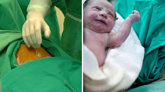 Cesarean Section: What to Expect?