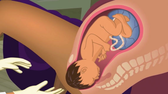 Childbirth: Steps to Vaginal Delivery