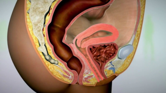 Chronic Pelvic Pain in Reproductive-age Women: How to Treat Endometriosis?
