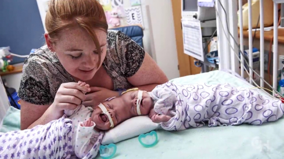 Conjoined Twins Abby and Erin Delaney: A Year in the Life