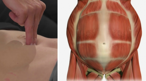 Diastasis Recti: How to Exercise with An Ab Separation After Pregnancy