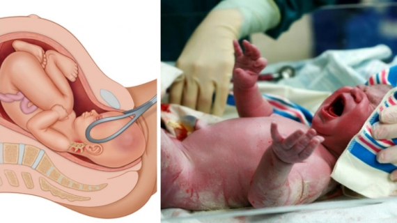 Different Types of Childbirth You Should Know