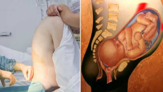 Epidural Pain Relief for Labor