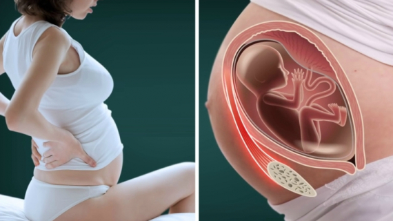 Every Pregnant Woman Should Know About Round Ligament Pain