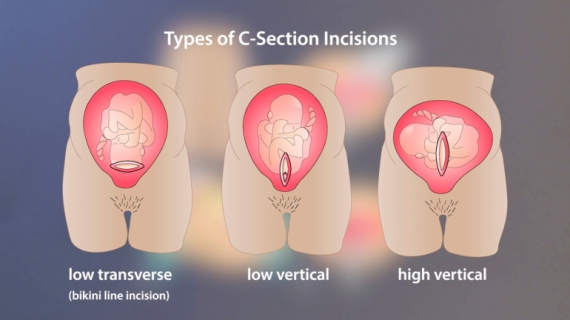 Everything You Need to Know About Cesarean Section