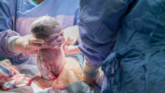 Gentle C-section: Liam's Birth Story