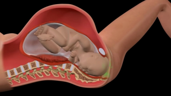 Group B Streptococcus Infection During Vaginal Birth