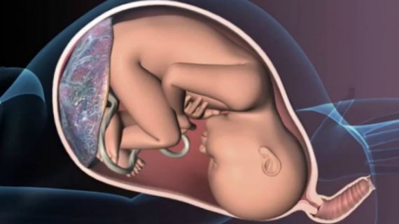 How Does Placental Abruption Affect Baby