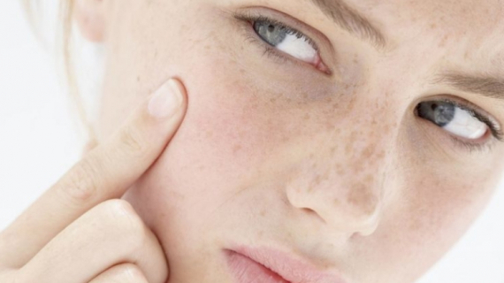 How to Clear up Acne While Pregnant