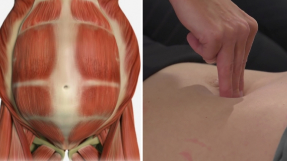 How to Do Exercise with Diastasis Recti?