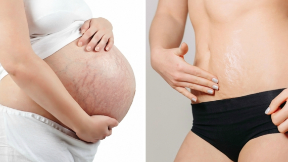 How to Get Rid of Stretch Marks After Pregnancy