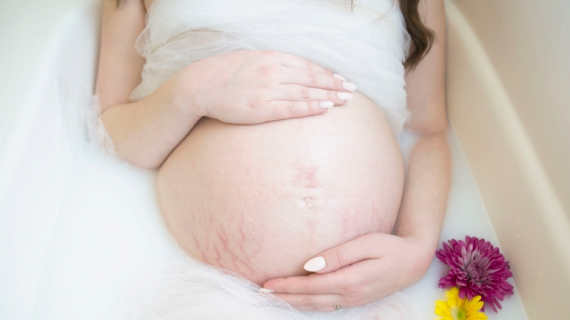 How to Minimize Pregnancy Stretch Marks: 7 Tips