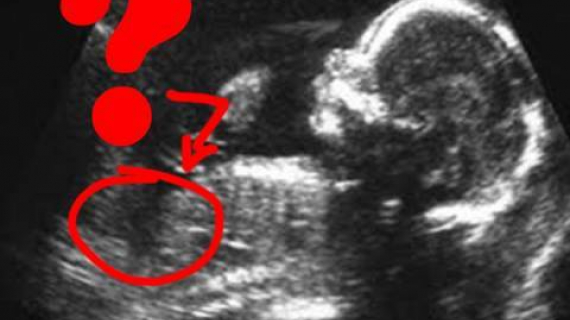 Is Your Baby a Boy or a Girl? 