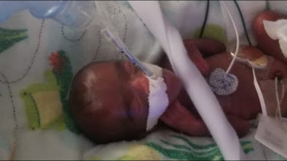 World’s Smallest Baby Born in San Diego at Sharp Mary Birch Hospital