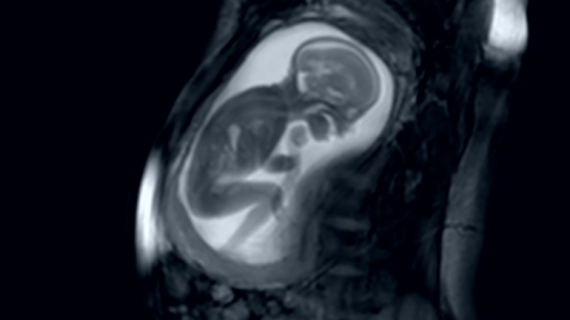 Incredible MRI Scan Shows Baby Moving in the Womb