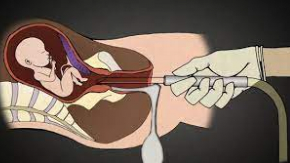 The Reality of 1st Trimester Surgical Abortions 