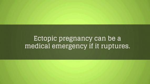 Ectopic Pregnancy