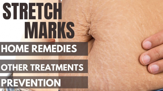 How to Get Rid of Stretch Marks Quickly 