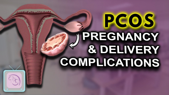 PCOS Pregnancy complications 