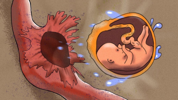 Ectopic Pregnancy - My Baby Grew Outside My Uterus in My Belly