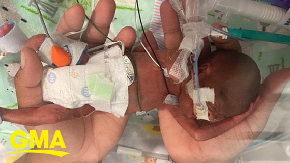 Baby born at 21 weeks named world’s most premature infant to survive