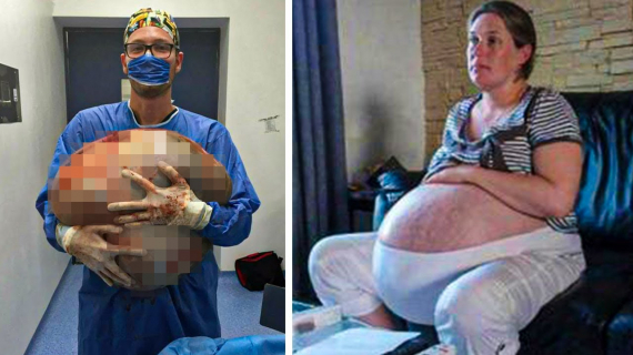 Woman looks like she’s pregnant with 10 children Then she sees scans and can’t believe her eyes 1