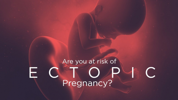 Are you at risk of Ectopic Pregnancy?