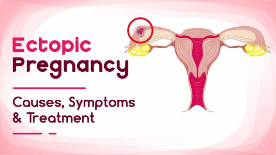 Ectopic Pregnancy - Reasons, Symptoms and Treatment