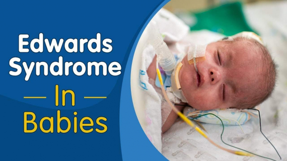 Edwards Syndrome in Babies