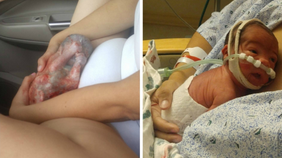 Mom Delivers Baby Still in Its Amniotic Sac While En Route to Hospital