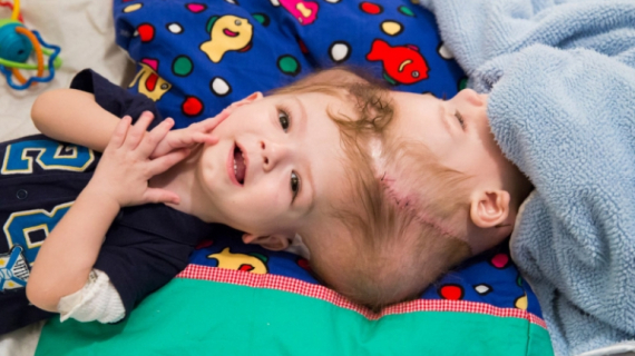 New Life: Rare Surgery to Separate Conjoined Twins