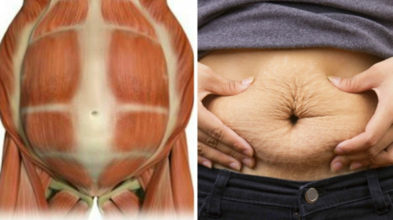 Diastasis Recti and Pregnancy