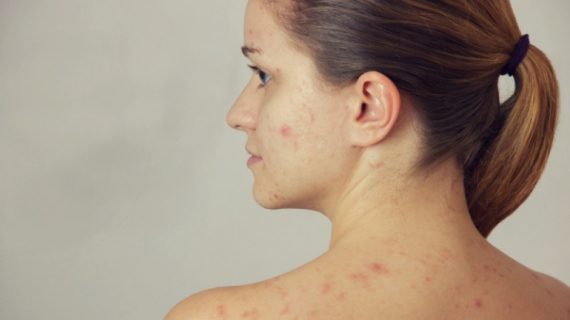 Pregnancy Skin Problems: How to Treat Acne During Pregnancy?