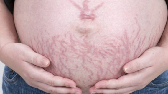 Pregnancy Stretch Marks: Prevention and Treatment