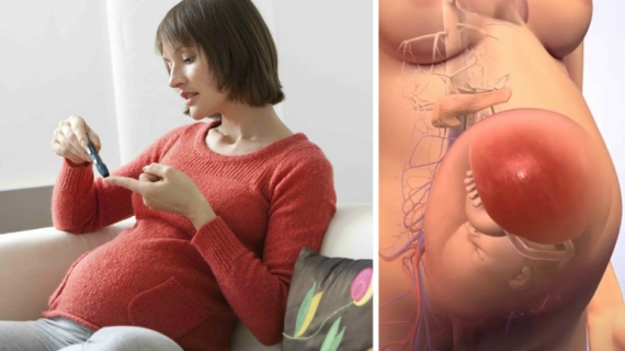 Prevention of Gestational Diabetes During Pregnancy