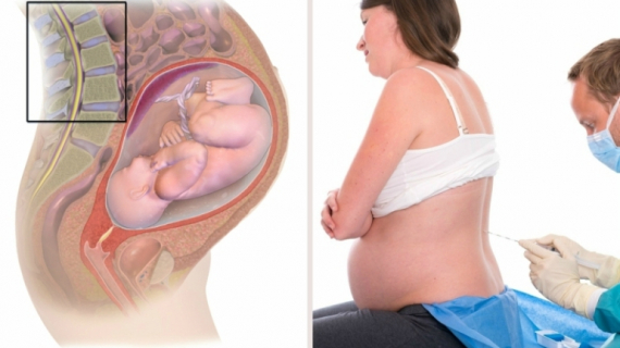 Pros and Cons of an Epidural During Labor