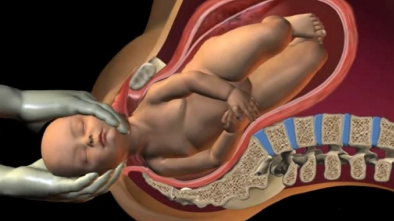 Shoulder Dystocia at Birth