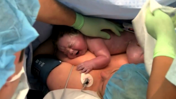 Skin-to-Skin Contact After Cesarean Birth