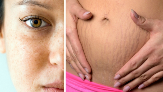 Stretch Marks and Skin Darkening After Childbirth