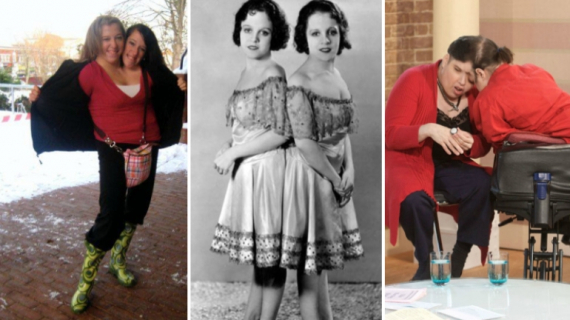 The Most Amazing Conjoined Twins