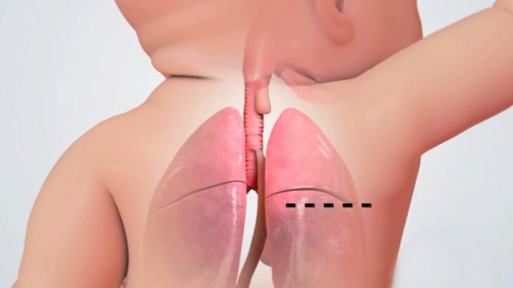 Tracheoesophageal Fistula Repair in Newborn Babies