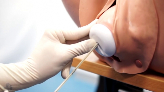 Ventouse Delivery (Vacuum Extraction) Technique