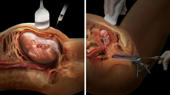 What Happens During a Chorionic Villus Sampling (CVS) Test?