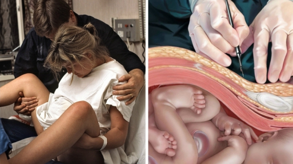 What Happens During Vaginal Birth and Cesarean Section?