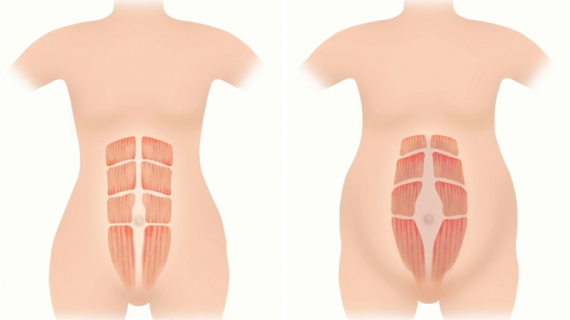 What Happens to Your Stomach Muscles During Pregnancy?