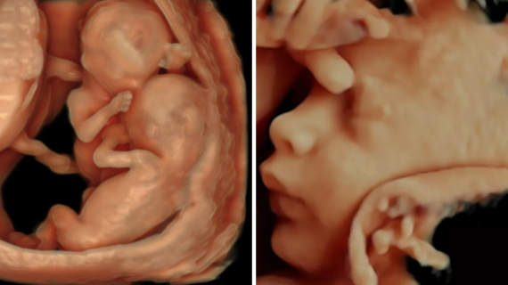 What is 4D Ultrasound: What is the Difference Between 3D and 4D?